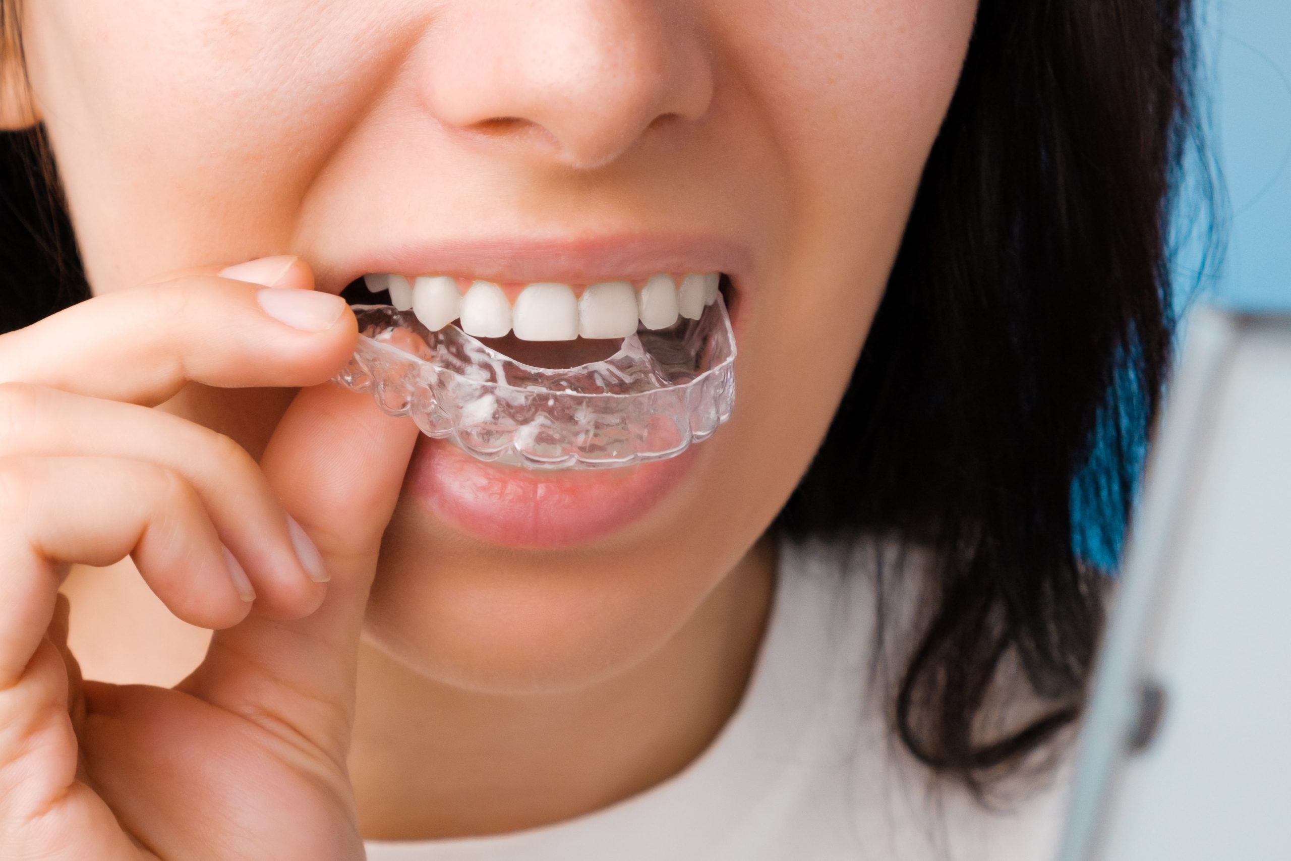 invisalign nowy dwór gdański